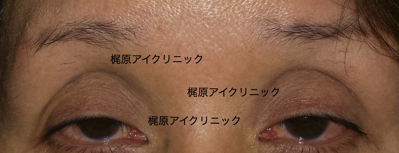眼瞼下垂と裏から行う手術 福岡市天神の眼科 梶原アイクリニック